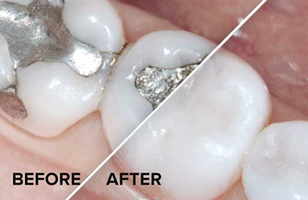 Before and After mercury fillings