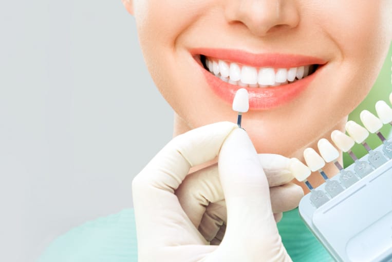 Close-up of a woman's smile with a dentist's gloved hand holding a dental shade guide near her teeth.