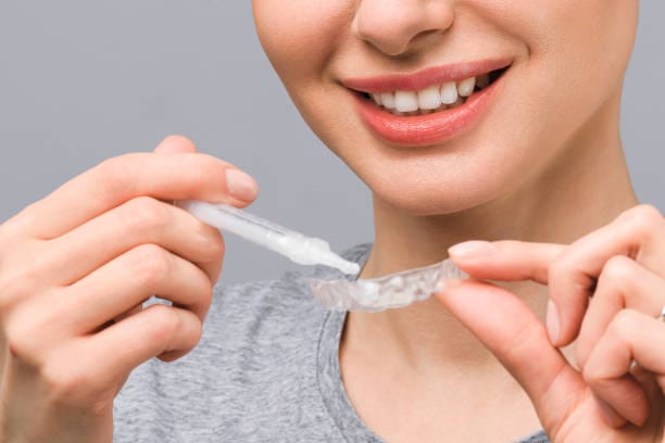 Close-up of a home teeth whitening tray with gel applied, designed to fit over the teeth.