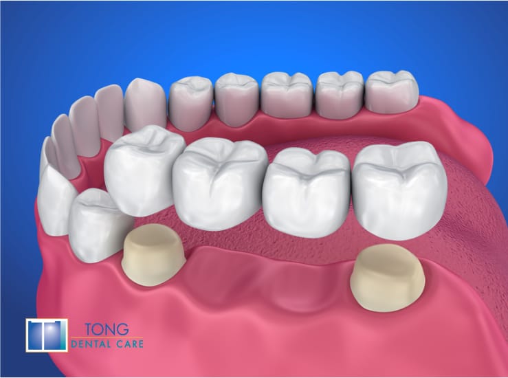 3D dental bridge