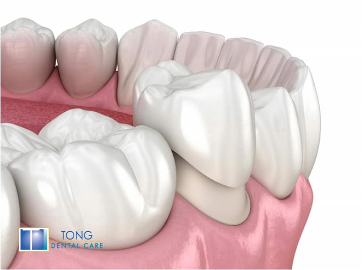 3D dental crown