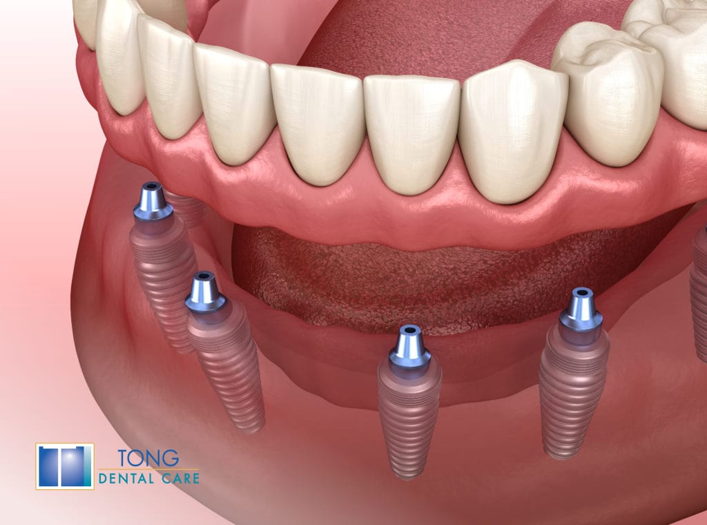 3D Implanted dentures