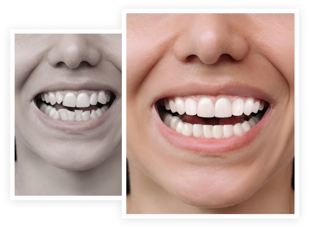 woman showing teeth before and after veneers